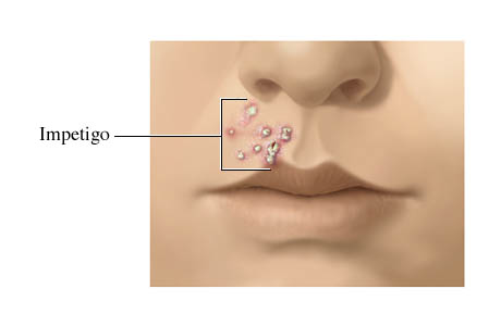 Impetigo القوباء الحصف