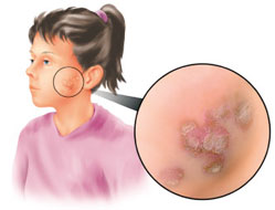 Impetigo قوباء حصف