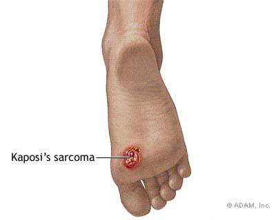 Kaposi's Sarcoma ورم كابوسي اللحمي