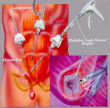 LAPAROSCOPIC_INGUINAL_HERNIA_REPAIR.jpg