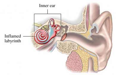 إلتهاب التيه Labyrinthitis