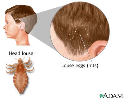 Lice قمل