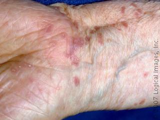 الحزاز الجلدي، حزاز مسطح Lichen Planus