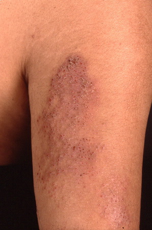 الحزاز البسيط المزمن Lichen simplex chronicus on the dorsal aspect of the upper arm of a 33-year-old patient with atopic dermatitis. The lesion was constantly rubbed and scratched and the extreme pruritus caused considerable discomfort