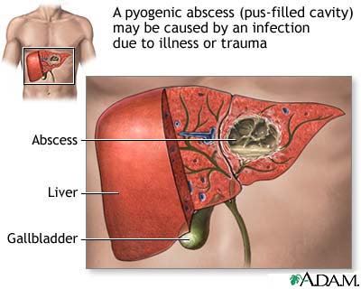 Liver Abscess خراج الكبد
