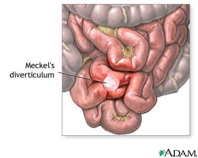 Meckel's Diverticulum