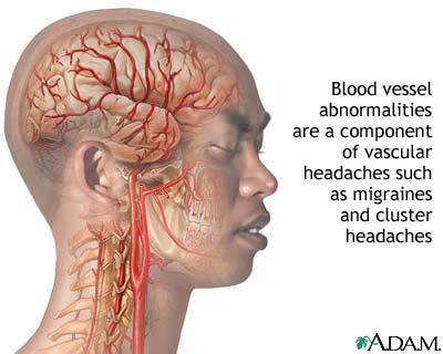 الصداع النصفي، صداع نصف الرأس، الشقيقة Migraine Headaches