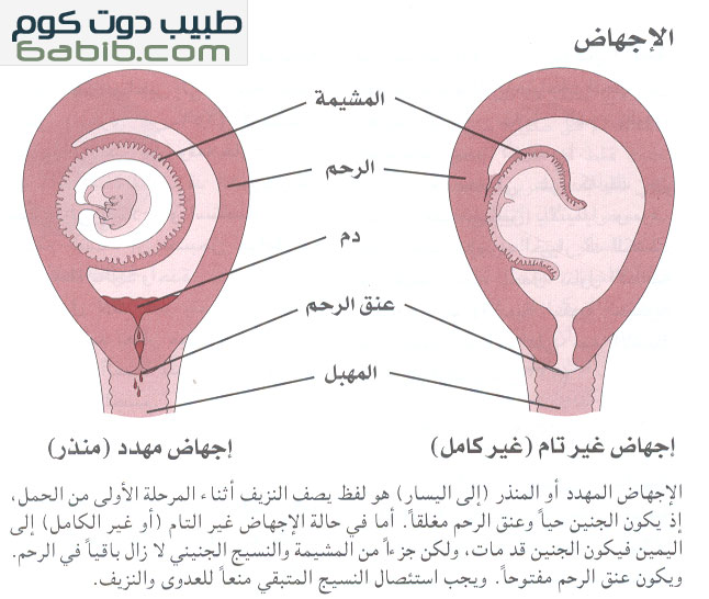 الاجهاض، سقوط الجنين Miscarriage