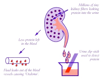 Nephrotic_Syndrome.jpg