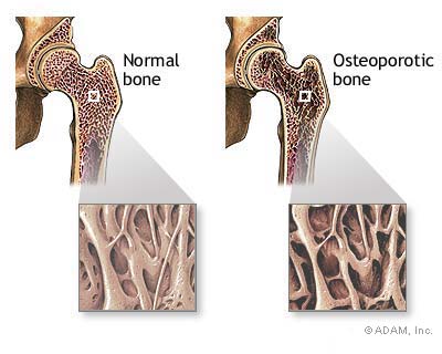 Osteoporosis.jpg