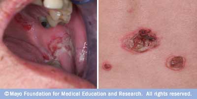 مرض الفقاع Pemphigus