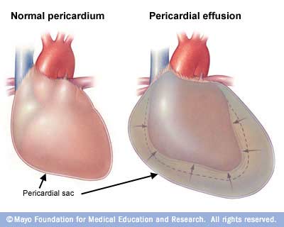 Pericarditis التهاب التامور، التهاب غلاف القلب