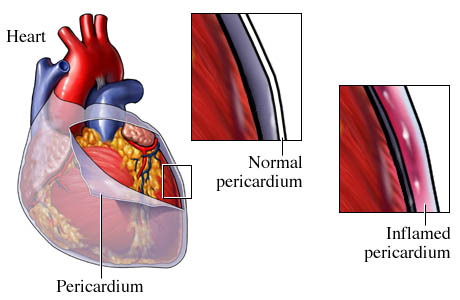 Pericarditis التهاب التامور، التهاب غلاف القلب