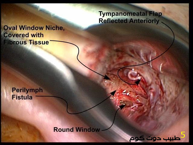 ناسور اللمف المحيط Perilymph Fistula