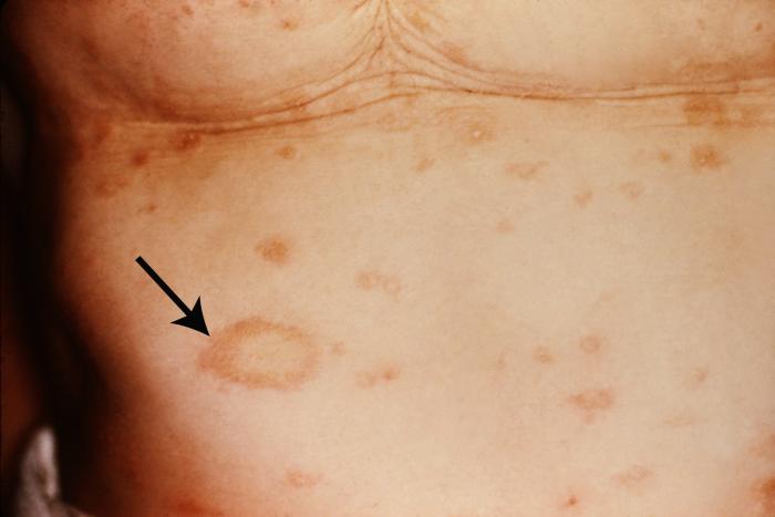 Pityriasis Rosea