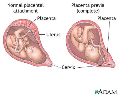 ‏المشيمة المتقدمة  (أو المنزاحة) Placenta Previa