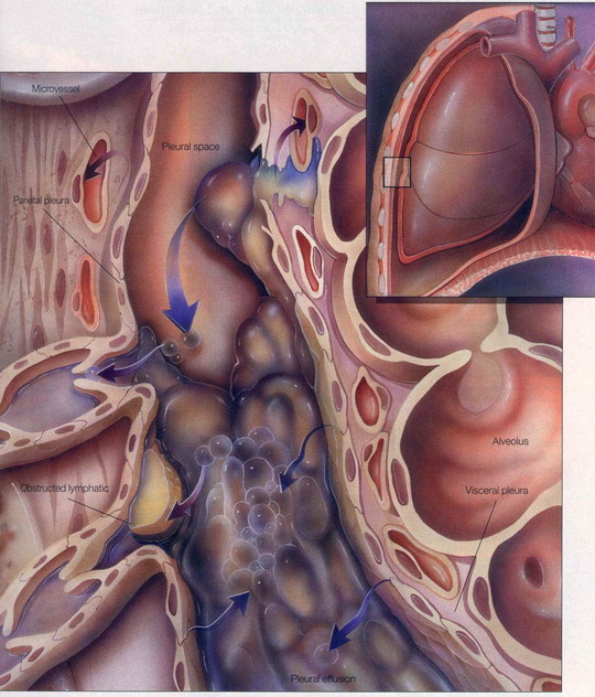 Pleural effusion