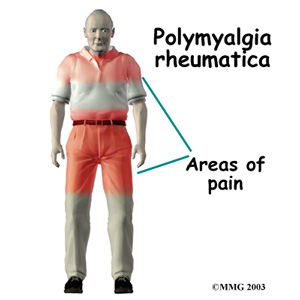 Polymyalgia Rheumatica