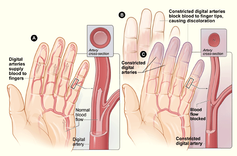 Raynaud-disease.gif