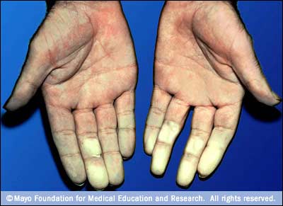 Raynaud disease