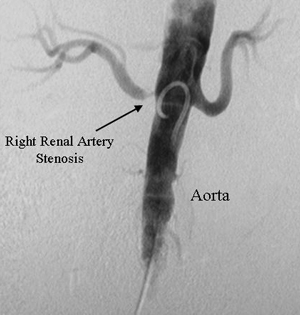 Renal_Artery_Stenosis.jpg