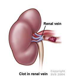 Renal Vein Thrombosis