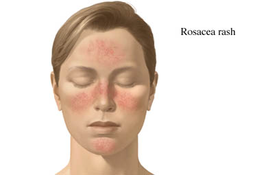 Rosacea الوردية، العد الوردي