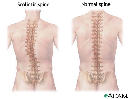 Scoliosis الجنف