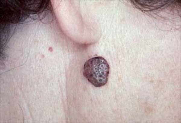 Seborrheic Keratoses التقرن الزهري (الدهني) السيلاني، التهاب الجلد المثي، التقرانات الدهنية