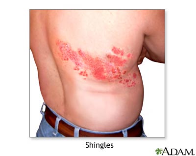 Shingles.jpg