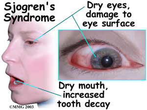 Sjogren's syndrome