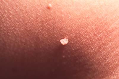 Skin Tag