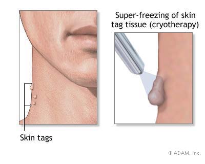 الزوائد الجلدية Skin Tags