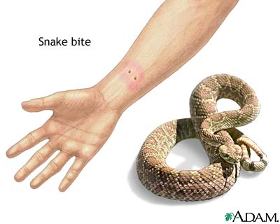 لدغة الثعبان Snake Bite