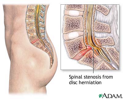 Spinal Stenosis الضيق الشوكي