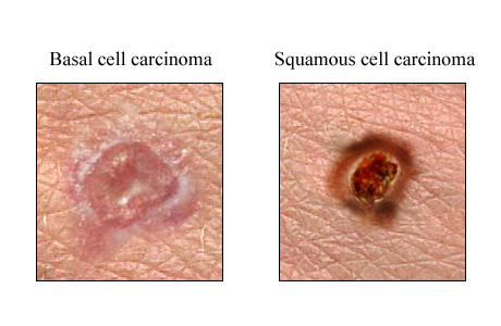 سرطان الخلية الحرشفية Squamous Cell Carcinoma