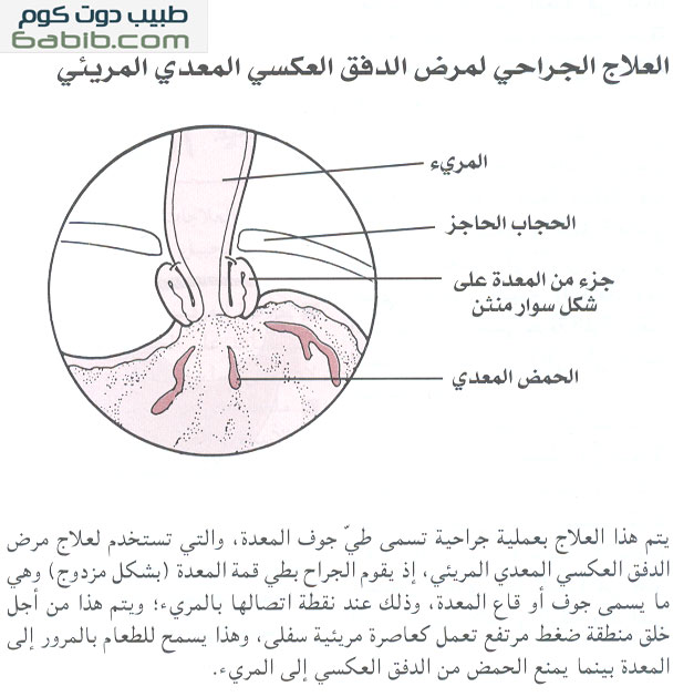 العلاج الجراحي لمرض ارتجاع المعدي المريئي Surgery for Gastroesophageal Reflux Disease