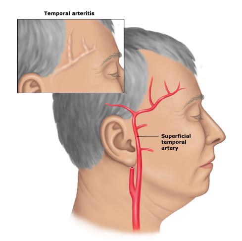 Temporal Arteritis