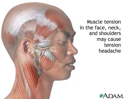 صداع التوتر، الصداع التوتري Tension Headaches