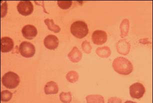 Thalassemia Major