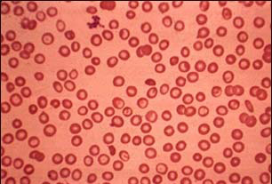 Thalassemia minor