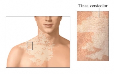 Tinea Versicolor