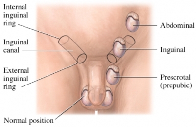 الخصية المعلقة أو الهاجرة Undescended Testis