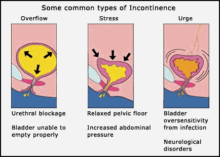 Urinary Incontinence سلس البول