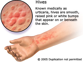 Urticaria, Hives ارتكاريا، شرى