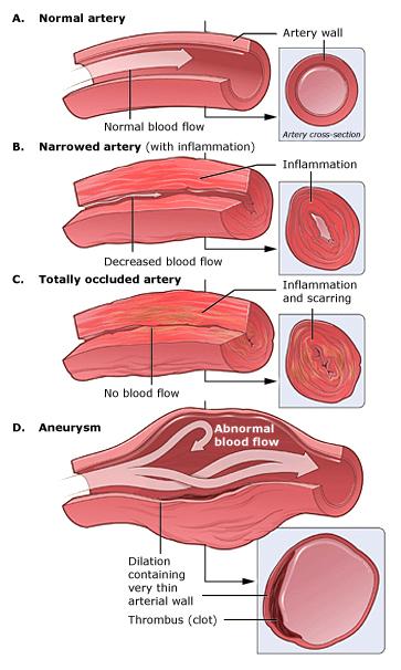 Vasculitis