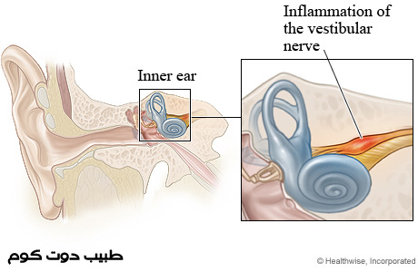 إلتهاب العصب الدهليزي Vestibular neuronitis