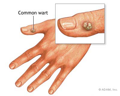 الثآليل، السنطة Warts