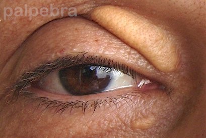 Xanthelasma