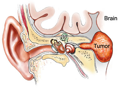 acoustic neuroma